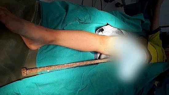 Tai nạn hy hữu, bé trai 6 tuổi bị thanh sắt 60cm đâm xuyên người Tai nạn hy hữu, bé trai 6 tuổi bị thanh sắt 60cm đâm xuyên người