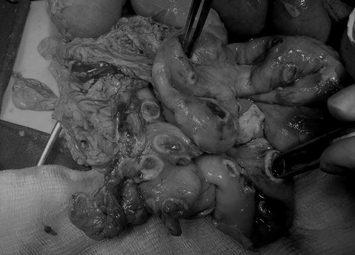 Nhiễm ấu trùng giun từ chó mèo, bé 2 tuổi bị đục thủng 50 lỗ trong ruột