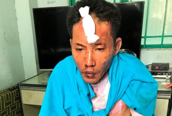 Bắt đối tượng tưới xăng đốt 3 mẹ con người tình bỏng nặng Bắt đối tượng tưới xăng đốt 3 mẹ con người tình bỏng nặng