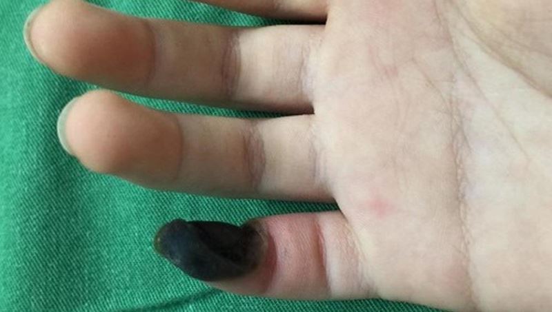 Tự lên mạng mua thuốc chữa mụn cóc, bé gái bị hoại tử ngón tay Tự lên mạng mua thuốc chữa mụn cóc, bé gái bị hoại tử ngón tay