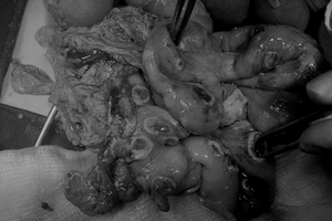 Nhiễm ấu trùng giun từ chó mèo, bé 2 tuổi bị đục thủng 50 lỗ trong ruột