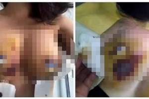 Hình ảnh nóng vụ “nâng ngực bị biến chứng” ở Bệnh viện thẩm mỹ Kim Cương A&B