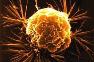 Tỷ lệ người mắc bệnh ung thư tăng cao