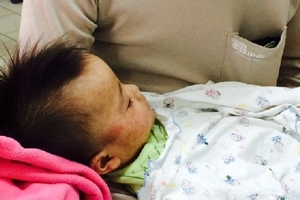 Yên Bái: Dịch bệnh sởi có xu hướng lan rộng ở vùng núi