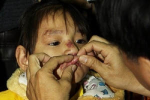 Khám bệnh miễn phí cho 200 bệnh nhân nghèo bị dị tật