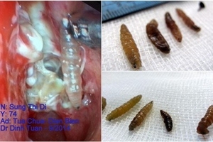 Kinh hãi gắp được 20 con giòi lúc nhúc trong mũi bệnh nhân