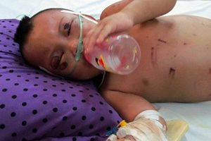 Bé trai 2 tuổi bị bà ngoại đánh phù não