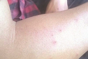 Côn trùng lạ cắn người