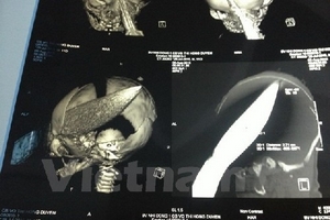 Sức khỏe bé trai sơ sinh bị dao đâm xuyên sọ đã phục hồi tốt