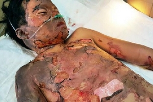 Bộ trưởng Y tế giúp cháu bé lớp 5 bị bỏng nửa người