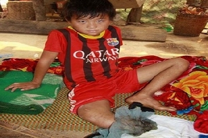 Cậu bé dân tộc Mông “xin cắt chân” đã được phẫu thuật thành công