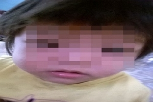 Cứu sống bé gái vừa lọt lòng mẹ đã bị bệnh suy tim hiếm gặp