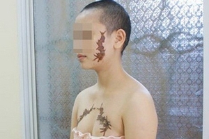 Cô gái mang hình xăm con rết thế nào sau 5 năm?