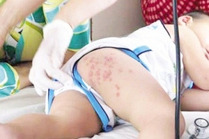 Cẩn trọng bệnh tay chân miệng “vào mùa”: Kiêng kỵ vô lối, bệnh càng nặng hơn