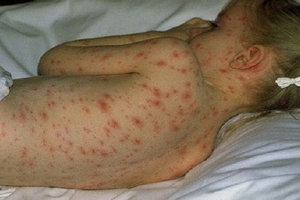 Bộ Y tế lý giải vì sao số ca sốt xuất huyết tăng chóng mặt