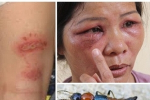 Hà Nội: Kiến ba khoang lộng hành, nhiều người bị đốt thê thảm