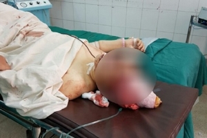 Đắk Nông: Cứu sống người vợ bị chồng chém vỡ sọ