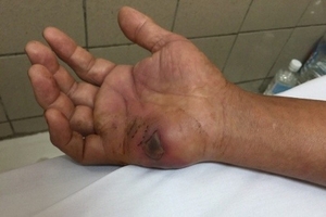 Rắn độc vào mùa, những sai lầm khiến nạn nhân có thể mất mạng