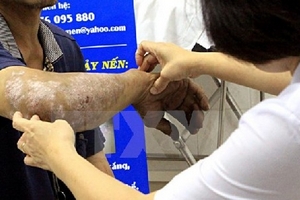 Thực hư thuốc điều trị Lupus ban đỏ không được bảo hiểm thanh toán