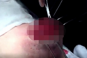 Hiểm họa khôn lường từ việc bơm silicon nâng ngực ở nữ giới