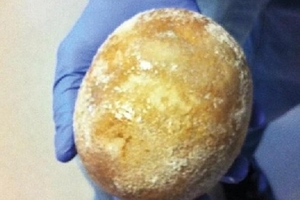 Viên sỏi bàng quang ‘khủng’ to như trứng đà điểu