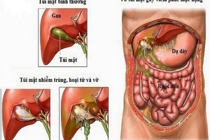 Viêm gan B, viêm túi mật - Sát thủ âm thầm của con người