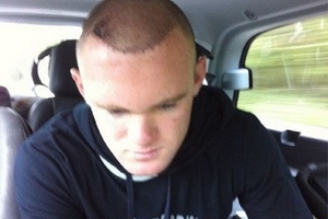 Rooney lộ đầu đầy sẹo sau khi đi chữa bệnh hói