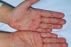 Có 12 ca nghi mắc bệnh tay chân miệng ở Hà Nội