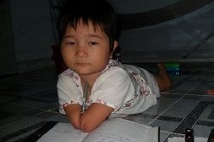 Cảm thương hoàn cảnh cháu bé mang thân hình “vây cá”