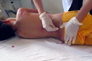 Bị chó becgiê cắn khắp người, bé gái nguy kịch