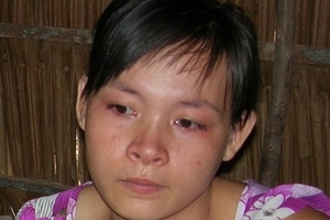 Xót lòng bé 5 tuổi bị mẹ kế đánh nhập viện