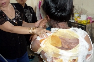 Phỏng nặng vì bị chồng tạt nồi nước sôi vào người