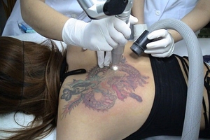 Hoảng hồn với thuốc xóa hình xăm "3 không"