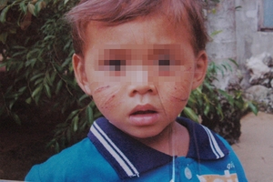 Quảng Ngãi: Bé trai 1 tuổi bị rạch mặt chằng chịt