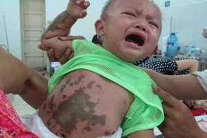 Một phụ nữ và 3 trẻ nhỏ bị tạt axit dã man