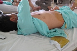 Nối thành công "của quý" bị vợ cắt tận gốc