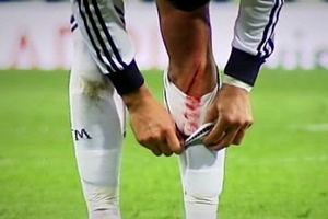 Ronaldo bị chảy máu, Real lo sốt vó