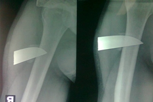 Rút lưỡi dao 7cm nằm trong người bệnh 4 tháng