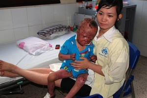 Bé 3 tuổi bị bố đẻ tưới xăng đốt giờ ra sao?