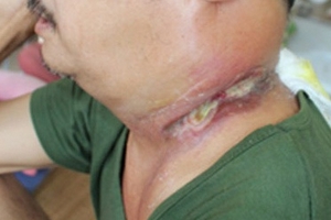 Suýt mất mạng vì đắp thuốc lá của thầy lang