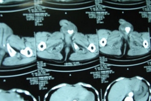 Lấy hai viên sỏi từ gốc 'cậu nhỏ'