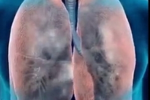 Mối đe dọa lớn của bệnh tắc nghẽn phổi mãn tính