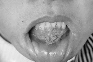 Trường trung học có 20 nam sinh bị sùi mào gà