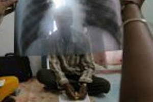 Kiểm tra lao phổi không cần chụp X-quang nhờ thiết bị mới