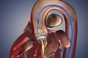 Nga ghép thành công mẫu van tim nhân tạo mới nhất