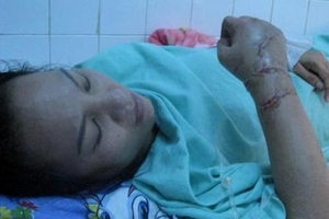 Sơ cứu khi bị đứt lìa tay, chân