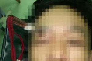 Tự đâm kéo vào mắt, may mắn không mù