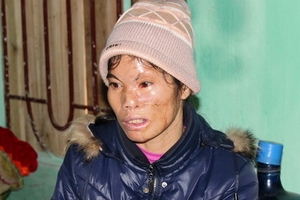 Tột cùng nỗi đau của người phụ nữ bị hắt hủi như quái vật