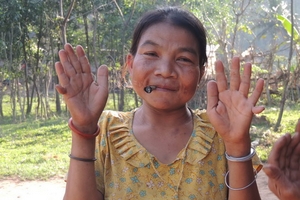 Chuyện kỳ lạ:  4 người có 14  ngón tay, ngón chân