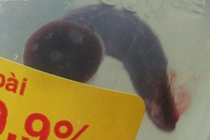 Tắm suối bị vắt dài hơn 3cm chui vào hốc mũi